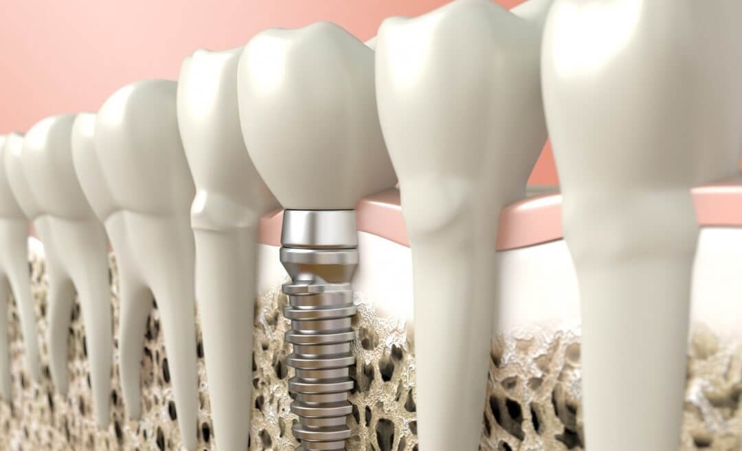 Dantų implantacija: ką svarbu žinoti prieš operaciją?