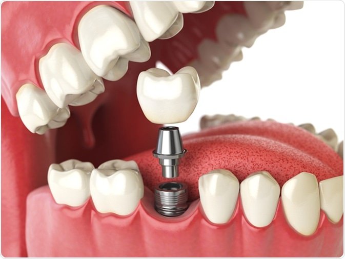 dantų implantas