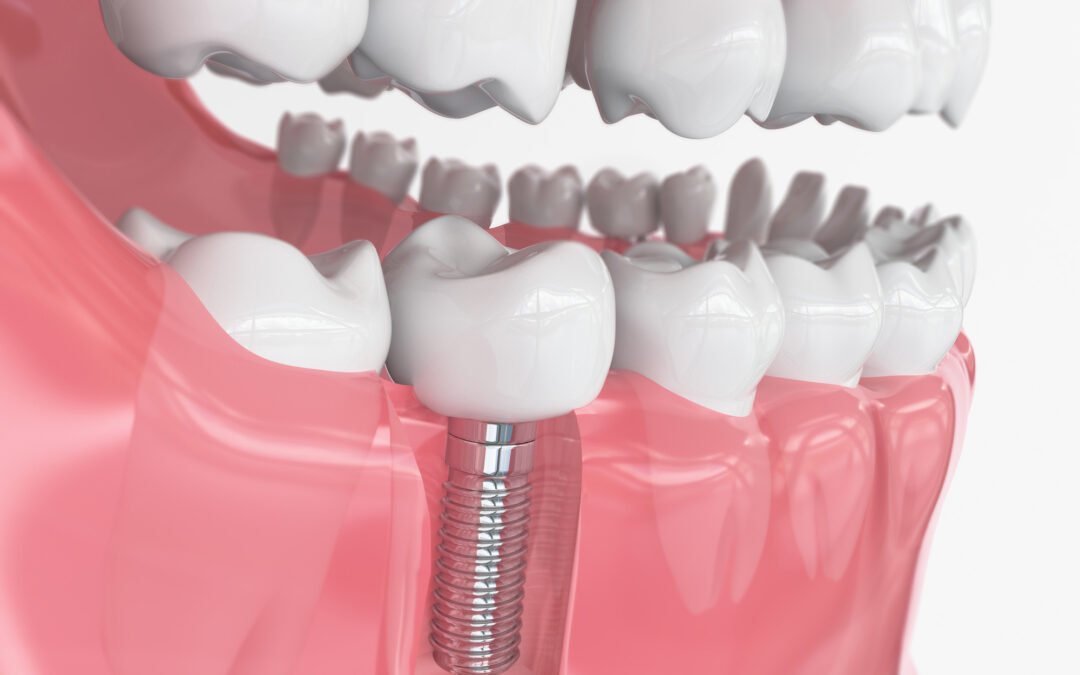 Dantų implantacija marijampoleje