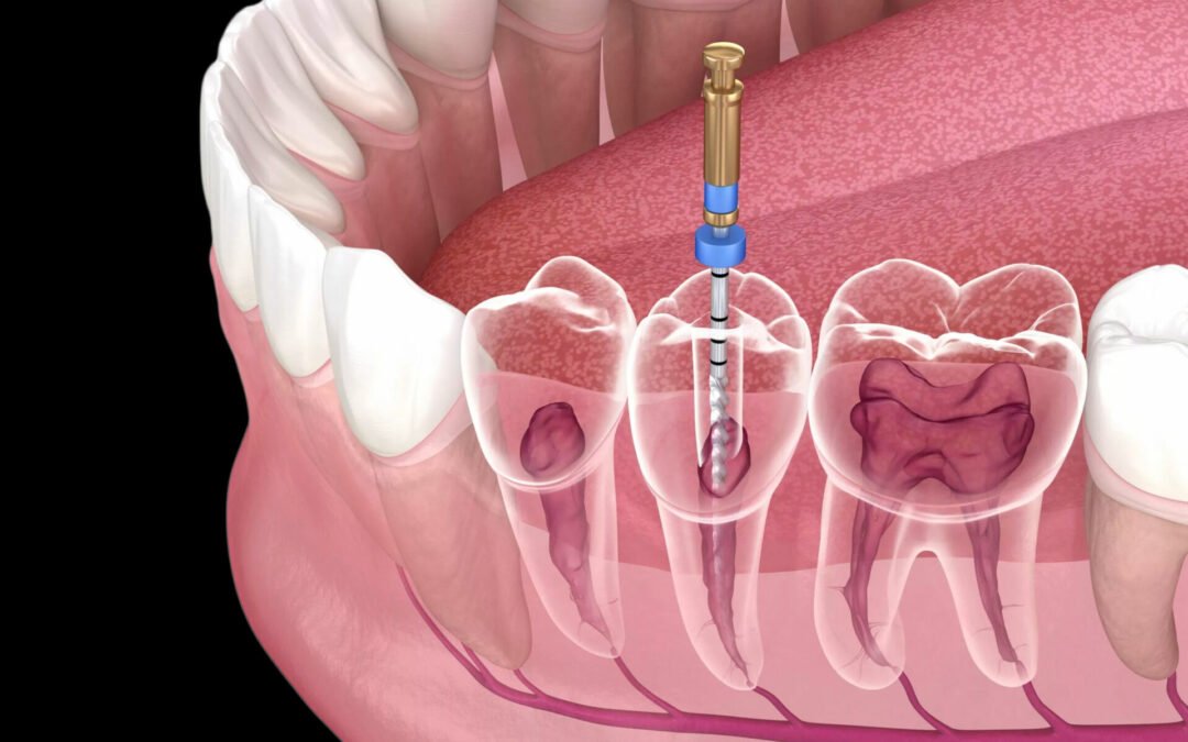 Ką reikia žinoti apie dantų kanalų gydymą?
